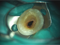 根管治療の顕微鏡写真